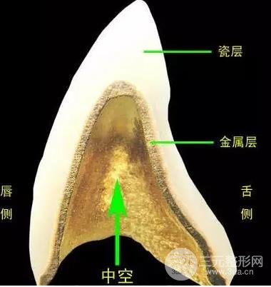 烤瓷牙適應(yīng)癥