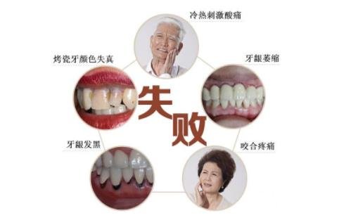 烤瓷牙的材料和價格