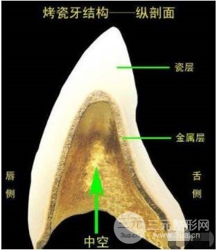 烤瓷牙結(jié)構(gòu)