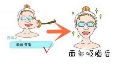 面部吸脂手術(shù)