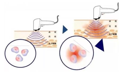 誰做過彩光嫩膚有果嗎