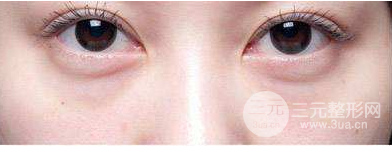 眼袋抽脂術的原理及果