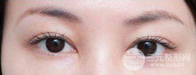 眼袋抽脂術的原理及果