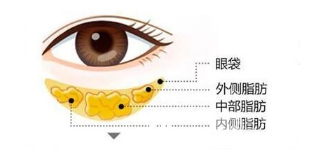 眼袋抽脂術的原理及果