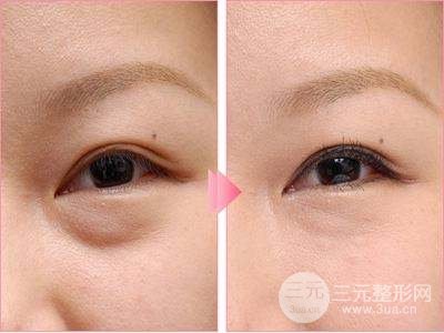 激光去眼袋多少錢 會反彈嗎