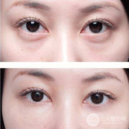 激光去眼袋多少錢 會反彈嗎