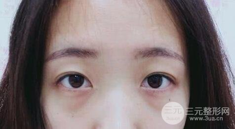 外切去眼袋手術(shù)果，會留疤嗎？