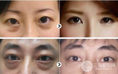 外切去眼袋手術(shù)案例