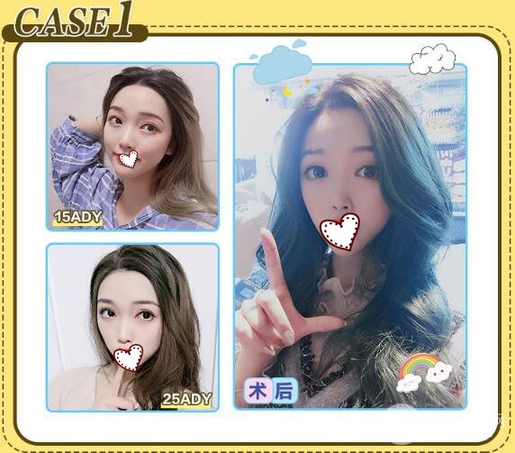 定點(diǎn)雙眼皮多少錢 可以保持多久？