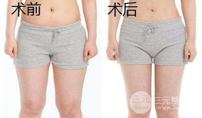 吸脂瘦大腿腫脹期是多久？多久能看到果？