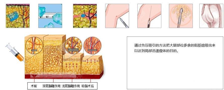 吸脂瘦大腿腫脹期是多久？多久能看到果？