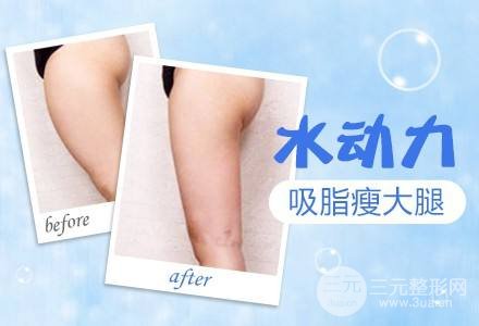 吸脂瘦大腿腫脹期是多久？多久能看到果？