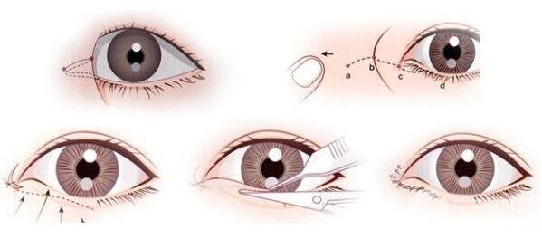 什么是開眼角手術(shù)?