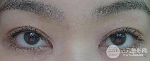 開眼角的術(shù)后注意事項