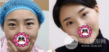 去眼袋后的注意事項(xiàng)