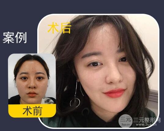 去頰脂墊手術(shù)果