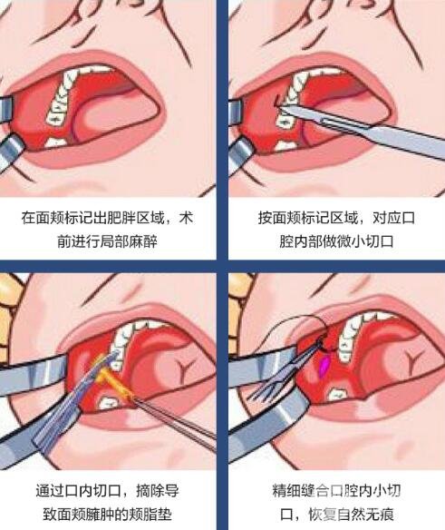 去頰脂墊手術(shù)如何操作?