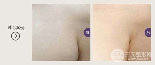 副乳吸脂有風(fēng)險嗎 輕松趕走“尷尬“贅肉!