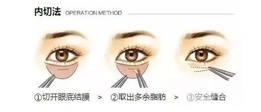 內(nèi)切祛眼袋后遺癥有哪些？幾天消腫？