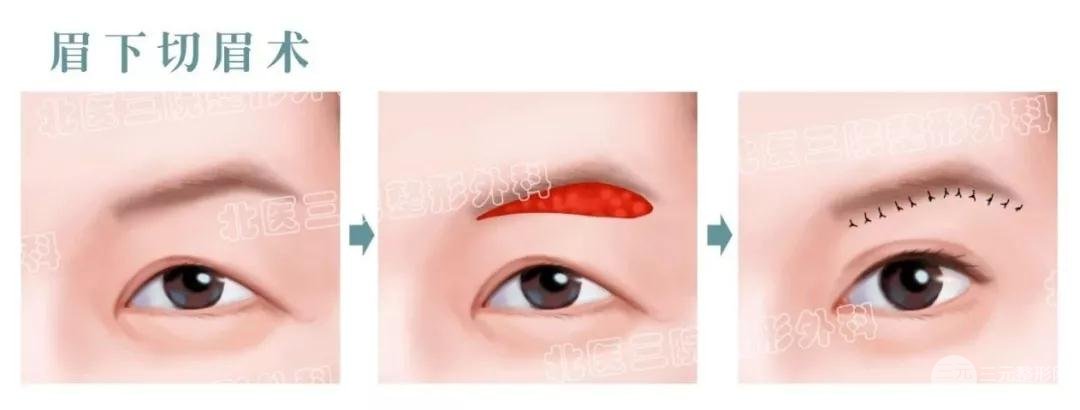切眉術(shù)適合多大年齡做