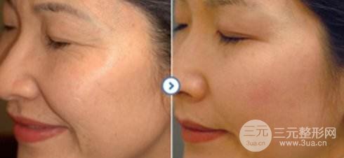 去皺多少錢 價(jià)格 方法 果圖