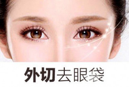 外切去眼袋多久恢復自然？看完你就懂了~