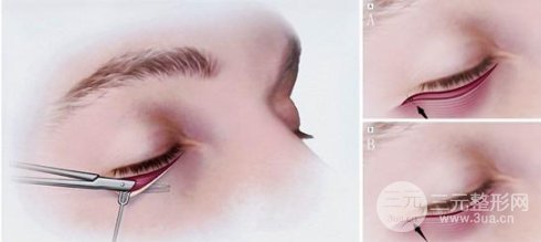 外切去眼袋多久恢復自然？看完你就懂了~