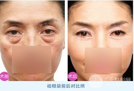 外切去眼袋多久恢復自然？看完你就懂了~