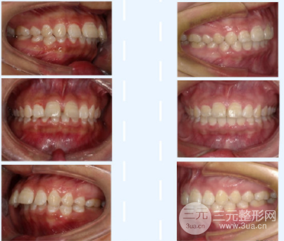 拔牙會(huì)讓牙齒松動(dòng)嗎