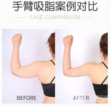 手臂抽脂多久恢復(fù)消腫？別著急，先做好這些事！