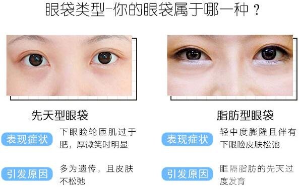 激光去眼袋多少錢？貴嗎？別讓你的眼袋越變越大！