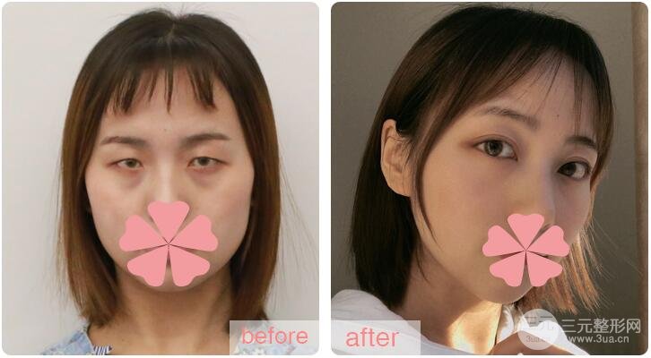 激光去眼袋多少錢？貴嗎？別讓你的眼袋越變越大！