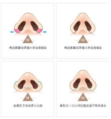 鼻翼缺損矯正手術(shù)適應(yīng)的人群