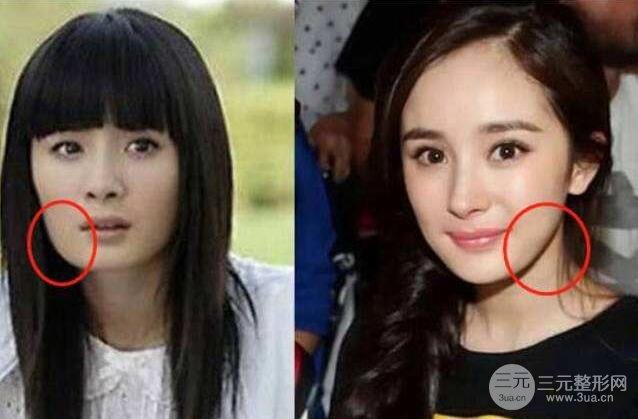 磨腮削骨多少錢？別怕貴，降低風(fēng)險(xiǎn)才重要！