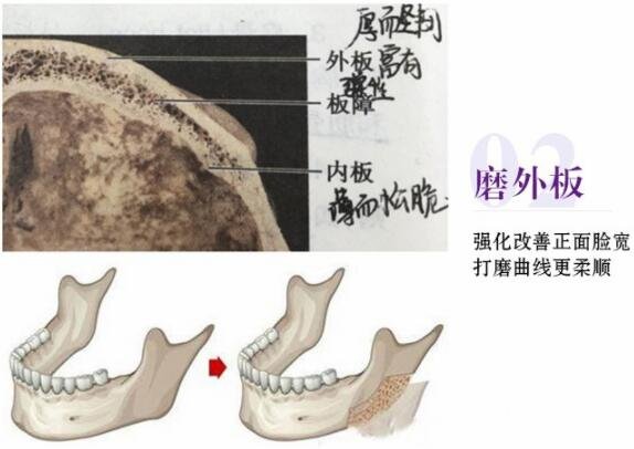 磨腮削骨多少錢？別怕貴，降低風(fēng)險(xiǎn)才重要！