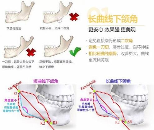 磨腮削骨多少錢？別怕貴，降低風(fēng)險(xiǎn)才重要！