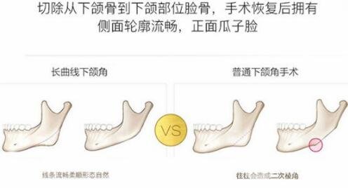 磨腮削骨多少錢？別怕貴，降低風(fēng)險(xiǎn)才重要！