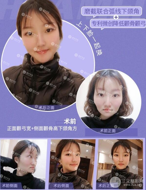 磨腮削骨多少錢？別怕貴，降低風(fēng)險(xiǎn)才重要！