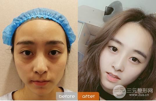 激光去眼袋的注意事項(xiàng)