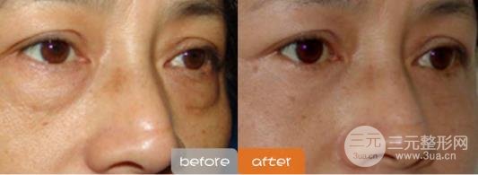 激光去眼袋的注意事項(xiàng)