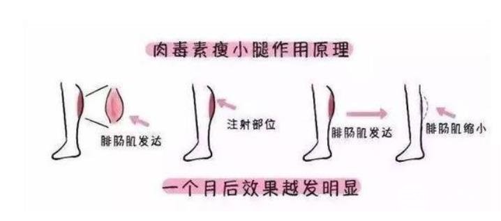 大腿肉注射瘦腿能打嗎？注射瘦腿的原理請(qǐng)重新審視一下！