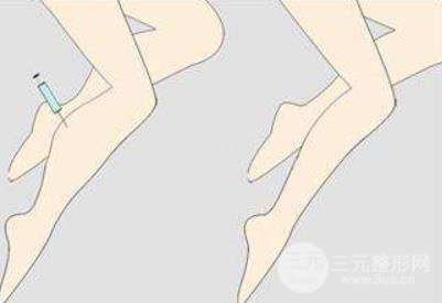 大腿肉注射瘦腿能打嗎？注射瘦腿的原理請(qǐng)重新審視一下！