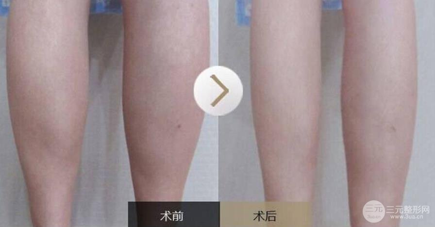 大腿肉注射瘦腿能打嗎？注射瘦腿的原理請(qǐng)重新審視一下！
