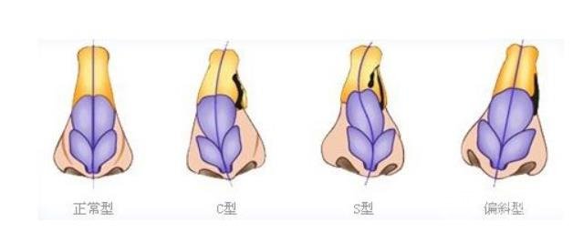 做取隆鼻假體修復(fù)術(shù)的補(bǔ)救措施，如何再次擁有美鼻