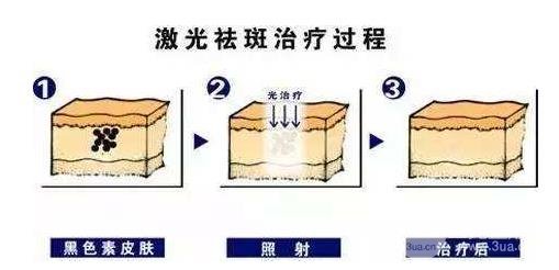 西京醫(yī)院激光祛斑價(jià)目表2020版 費(fèi)用解析大全~ 