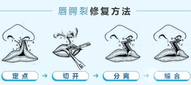 科普：兔唇手術(shù)多少錢？