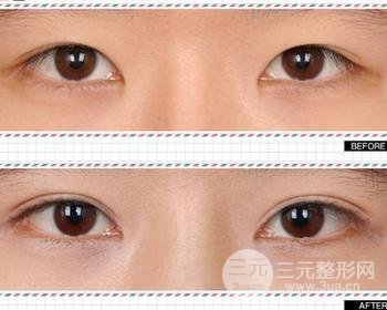 割雙眼皮對比圖，光看這些圖片就能感受到手術(shù)的優(yōu)勢