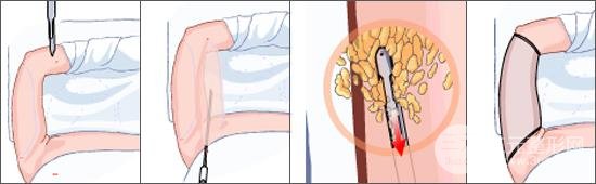 手臂抽脂多少錢？這個夏日甩掉蝴蝶臂吧~