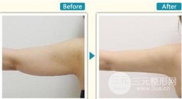 手臂抽脂多少錢？這個夏日甩掉蝴蝶臂吧~