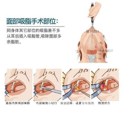 光纖溶脂瘦臉是長時間的嗎?